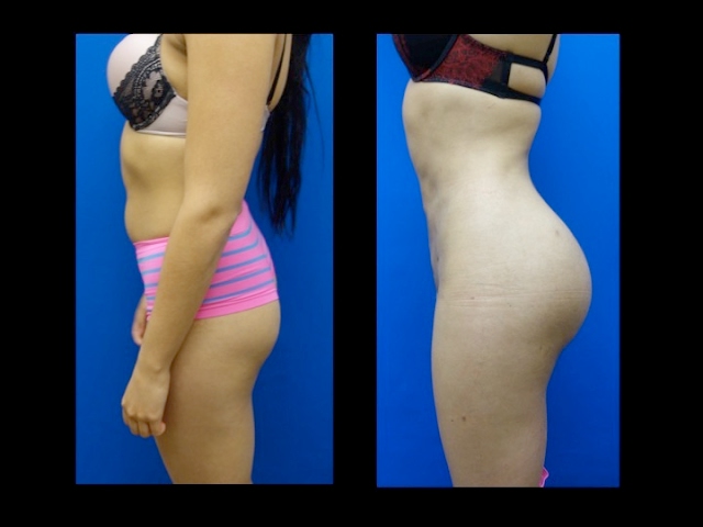 Cirugia De Implante De Gluteos Fallida Wilberto Cortes M D