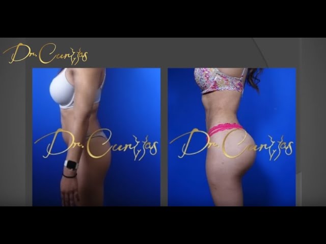 La Transferencia De Grasa Es Menos Dolorosa Que Una Cirugia De Implantes De Gluteos Wilberto Cortes M D